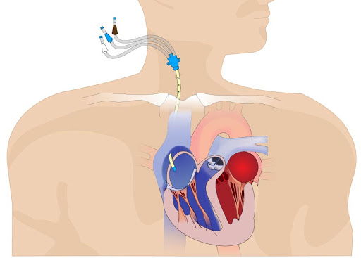 آموزش نصب CVP | مراحل، نکات ایمنی و عوارض احتمالی